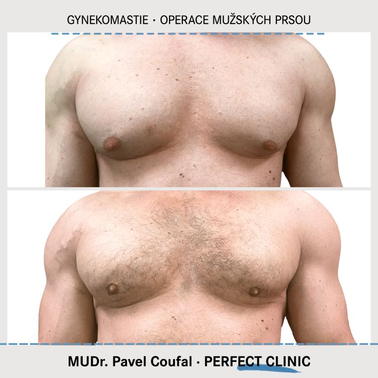 Gynekomastie