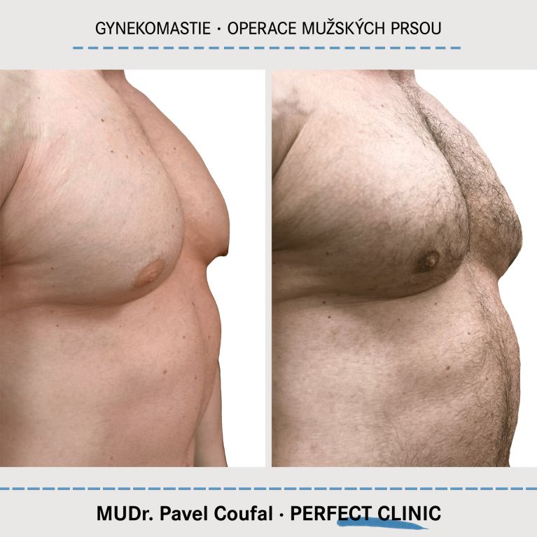 Gynekomastie