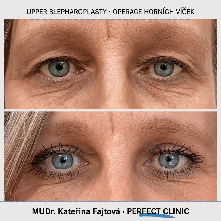 Operace horních víček
