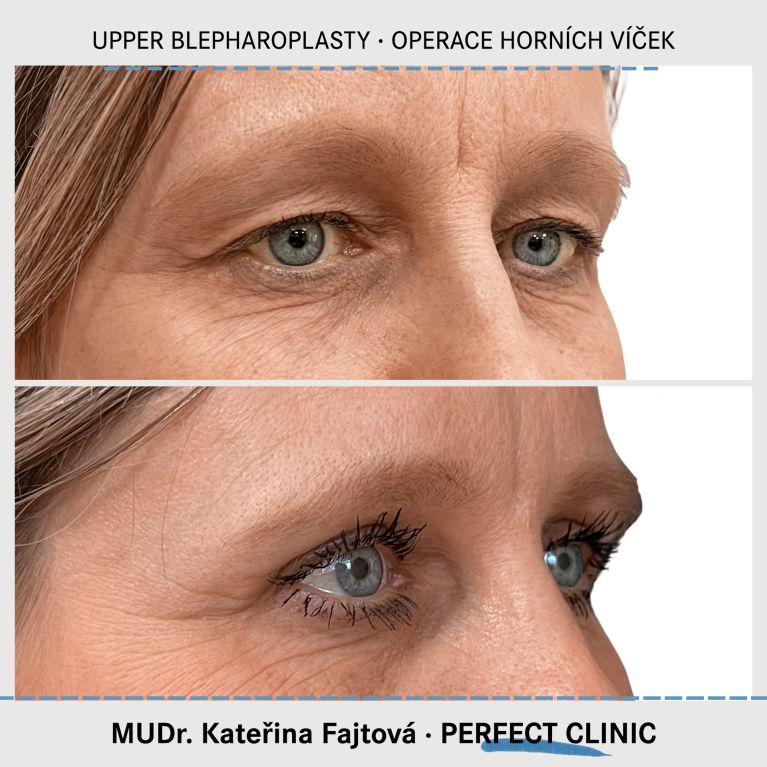 Operace horních víček
