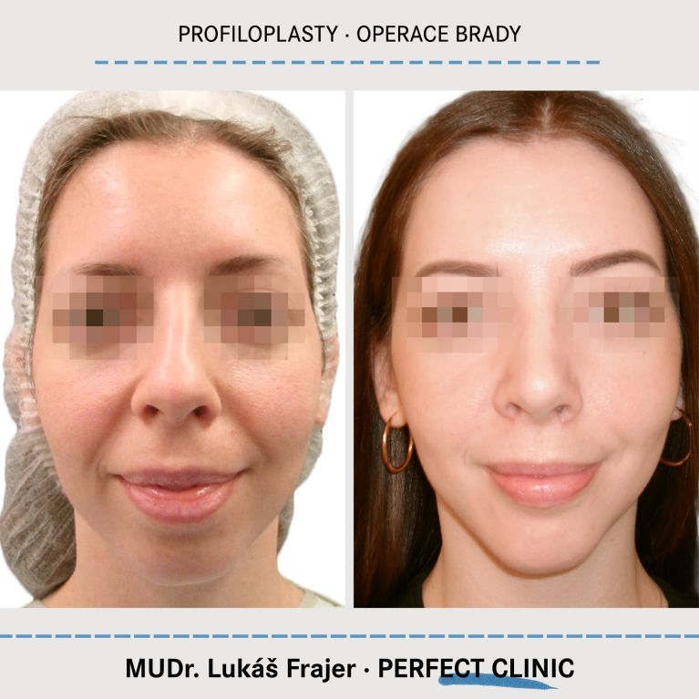 Plastická operace brady