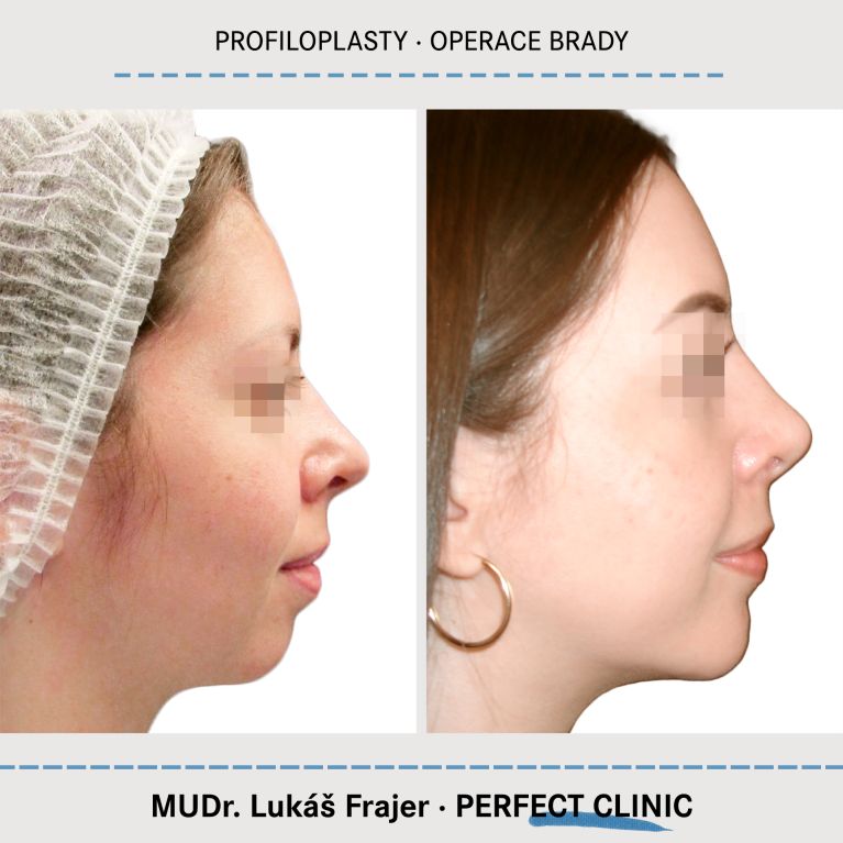 Plastická operace brady