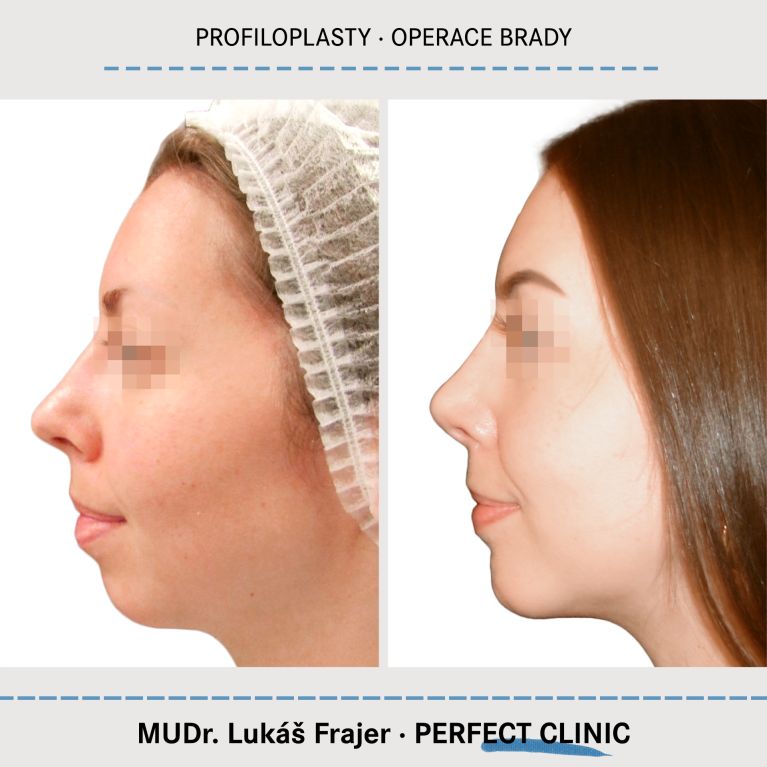 Plastická operace brady