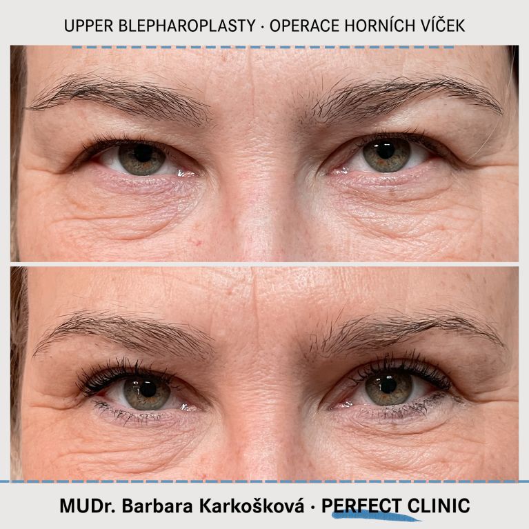 Operace horních víček