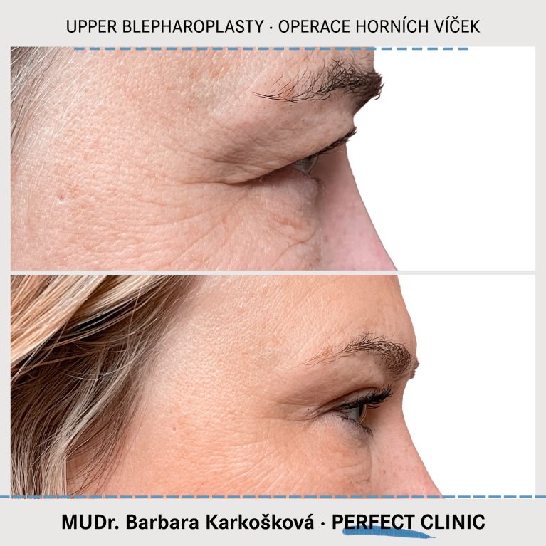 Operace horních víček