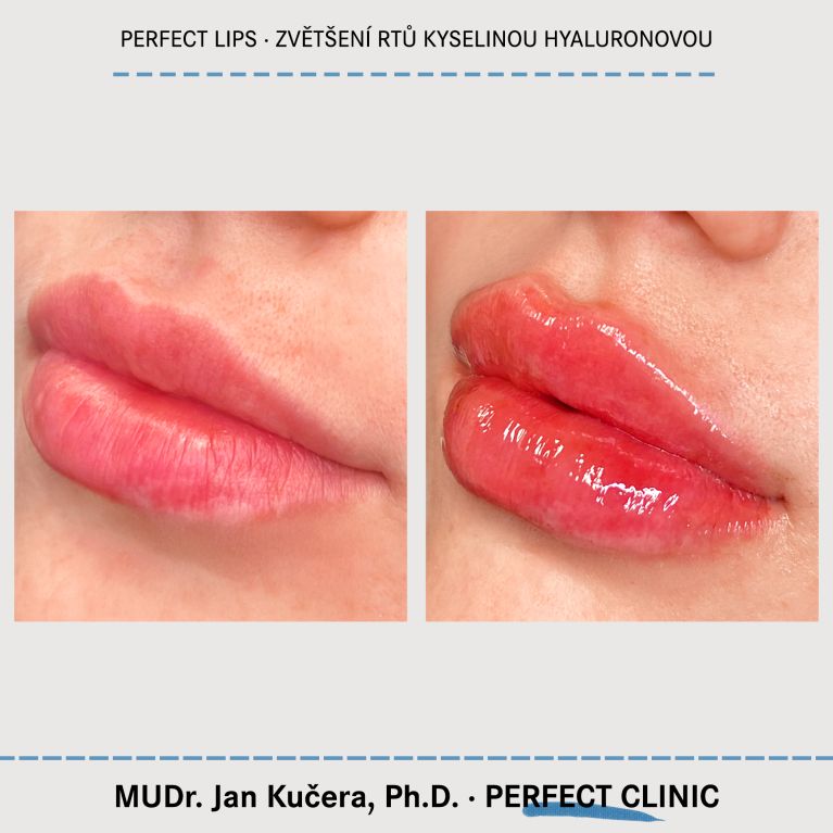 Zvětšení rtů kyselinou hyaluronovou