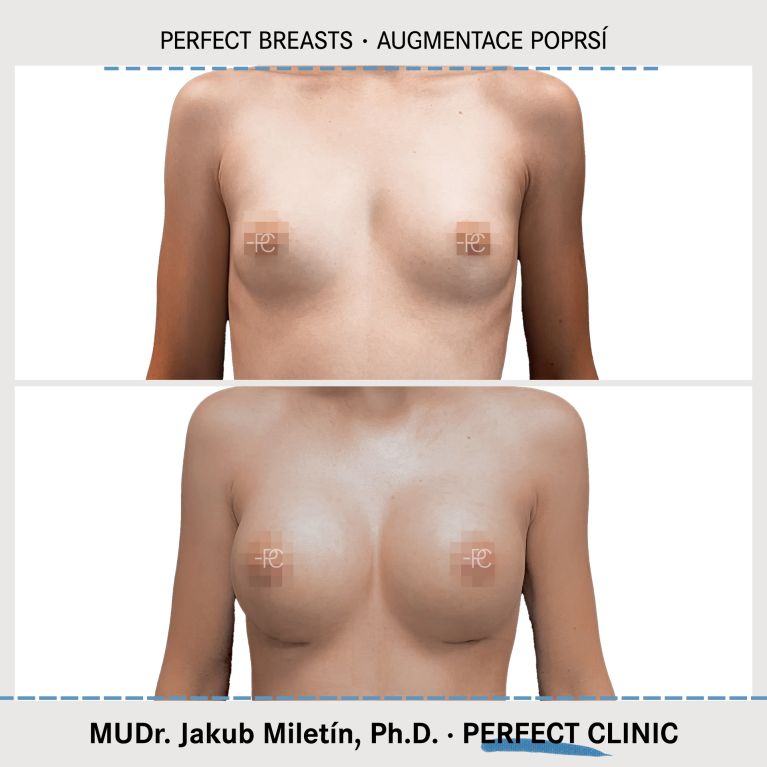 Augmentace poprsí
