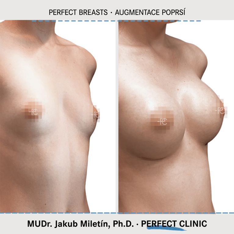 Augmentace poprsí