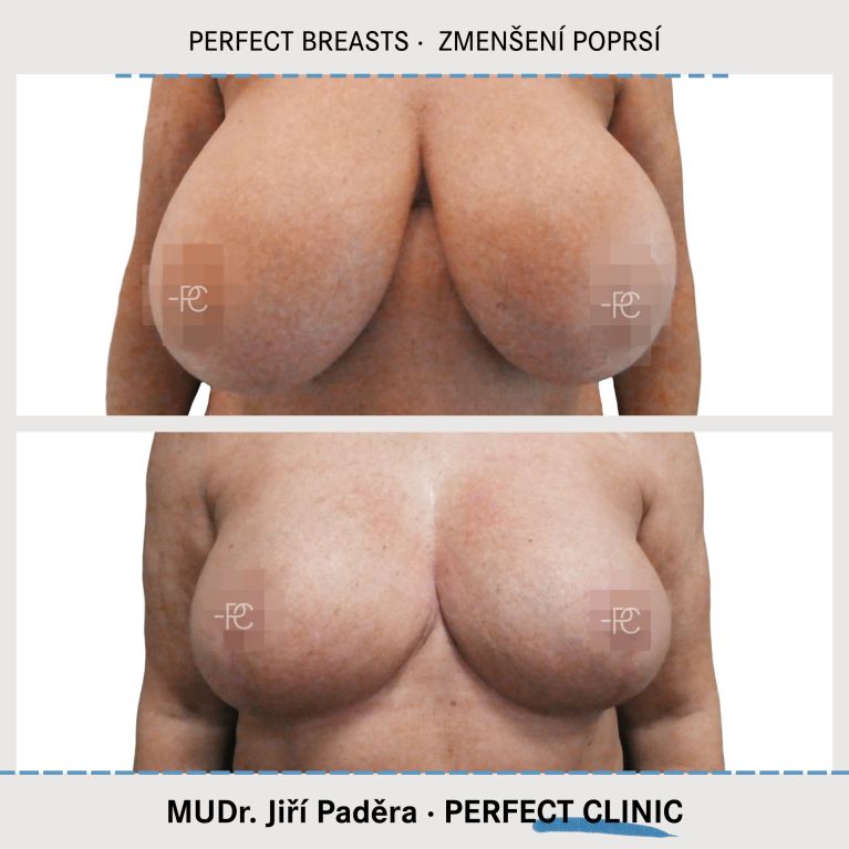 Zmenšení prsou