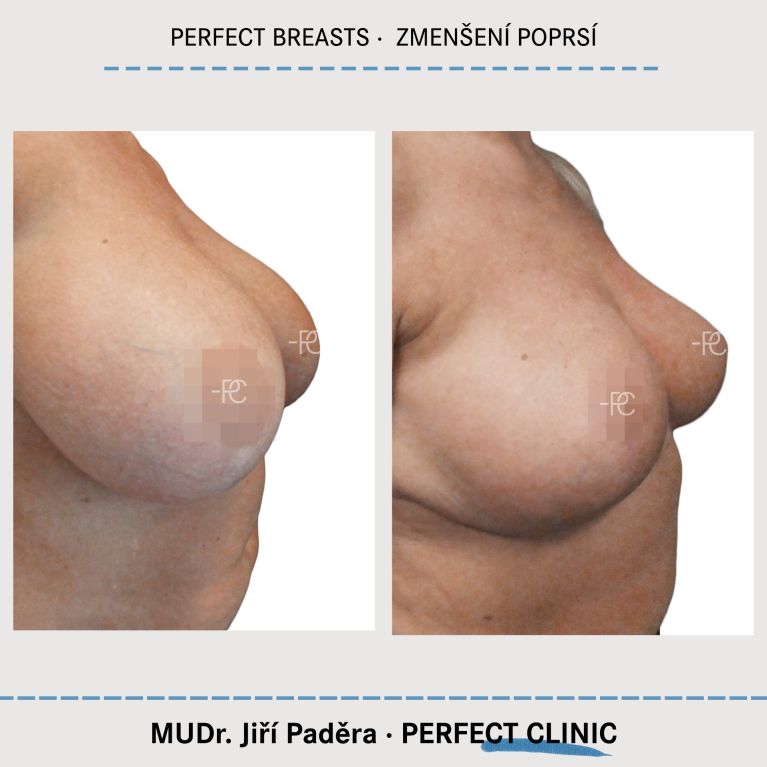 Zmenšení prsou