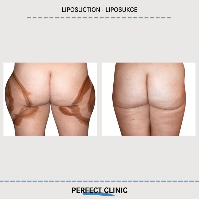 Liposukce