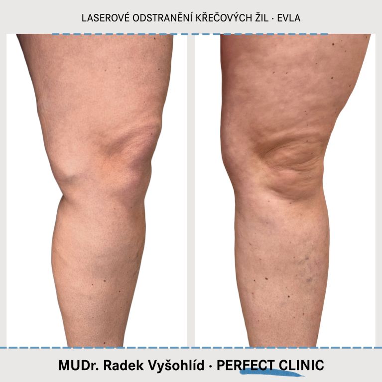 EVLA – Endovenózní laserová ablace