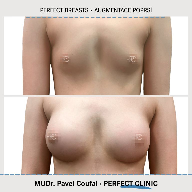 Augmentace poprsí