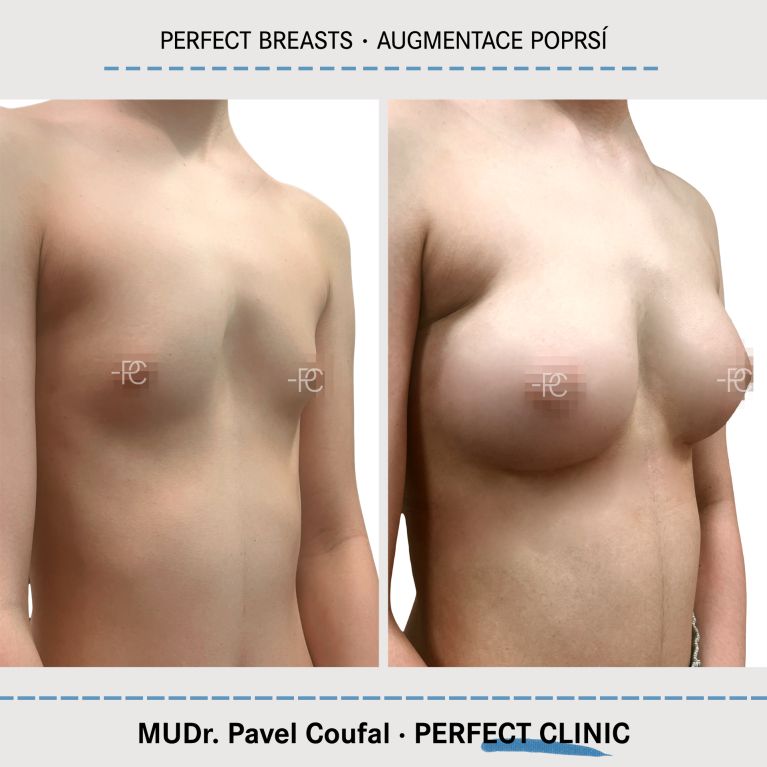 Augmentace poprsí