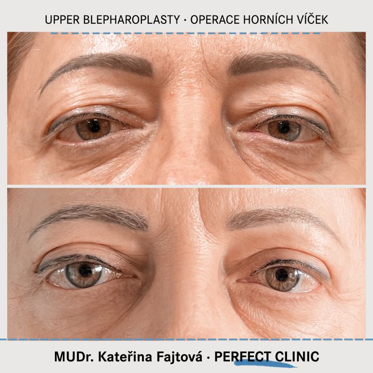Operace horních víček