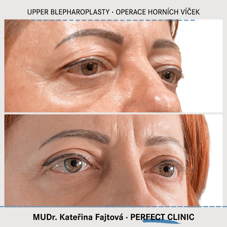 Operace horních víček