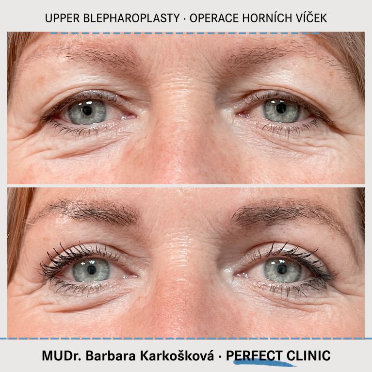 Operace horních víček