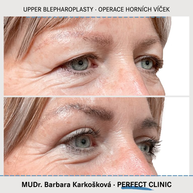 Operace horních víček