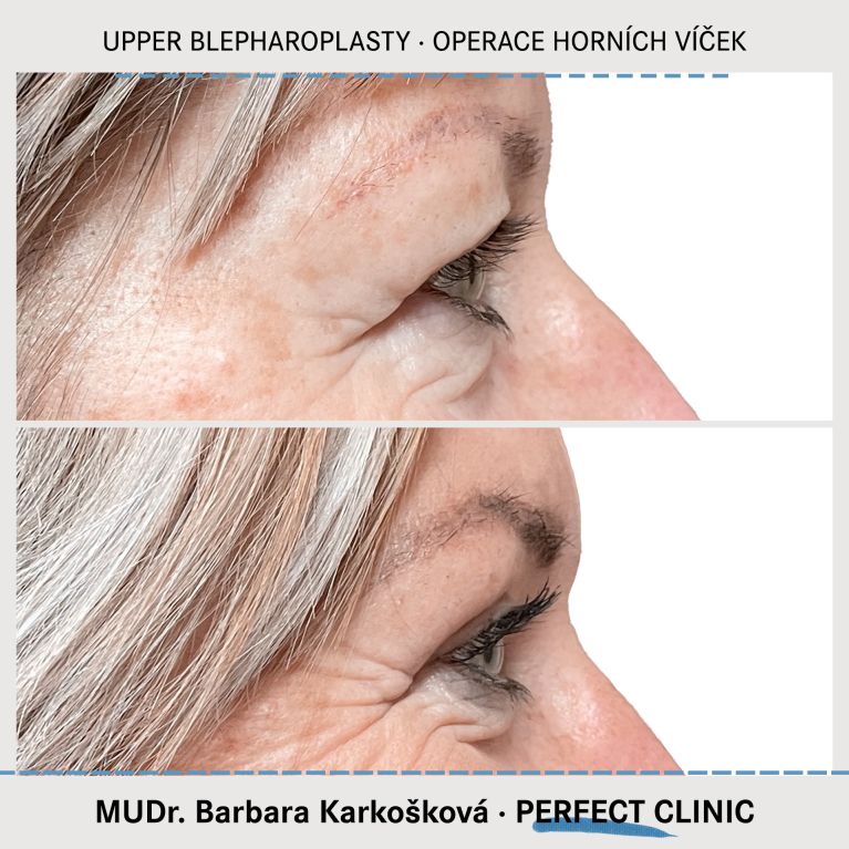Operace horních víček