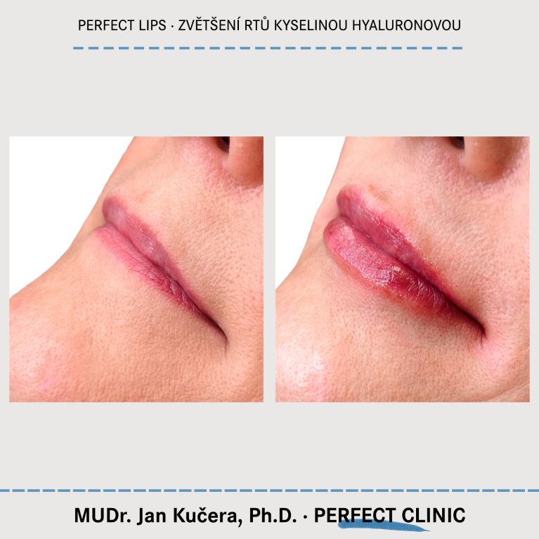 Zvětšení rtů kyselinou hyaluronovou