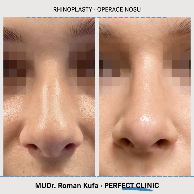 Rhinoplastika