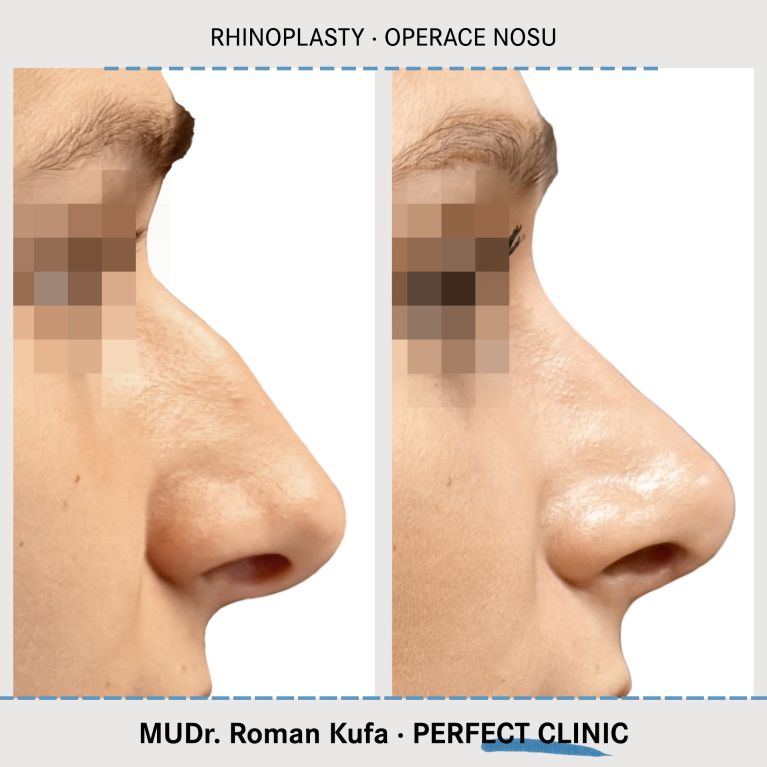 Rhinoplastika