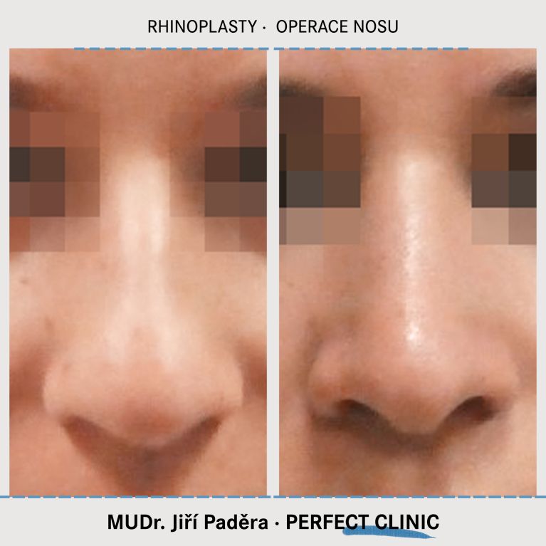 Rhinoplastika