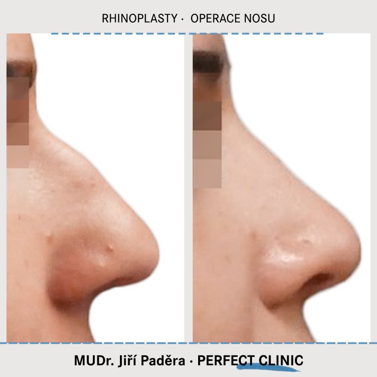 Rhinoplastika