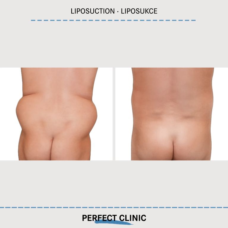 Liposukce