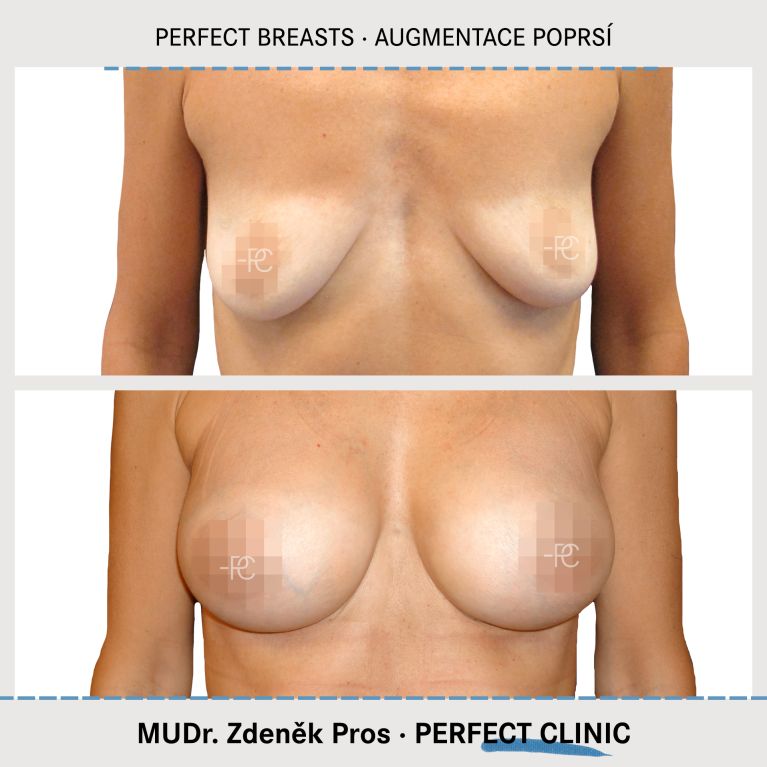 Augmentace poprsí