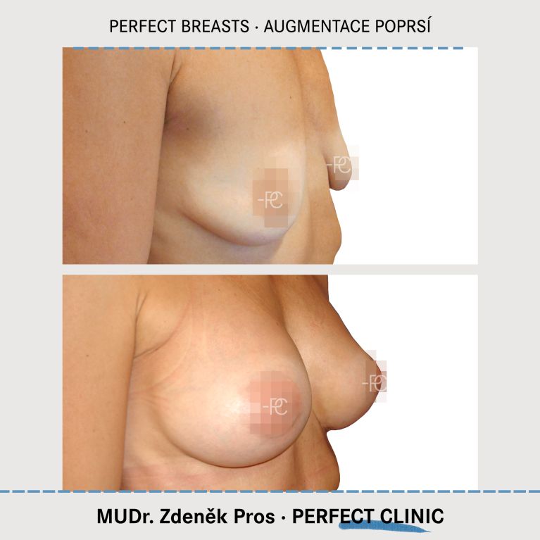 Augmentace poprsí