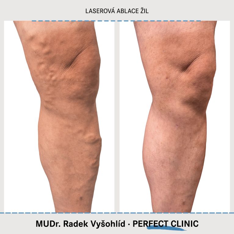 EVLA – Endovenózní laserová ablace