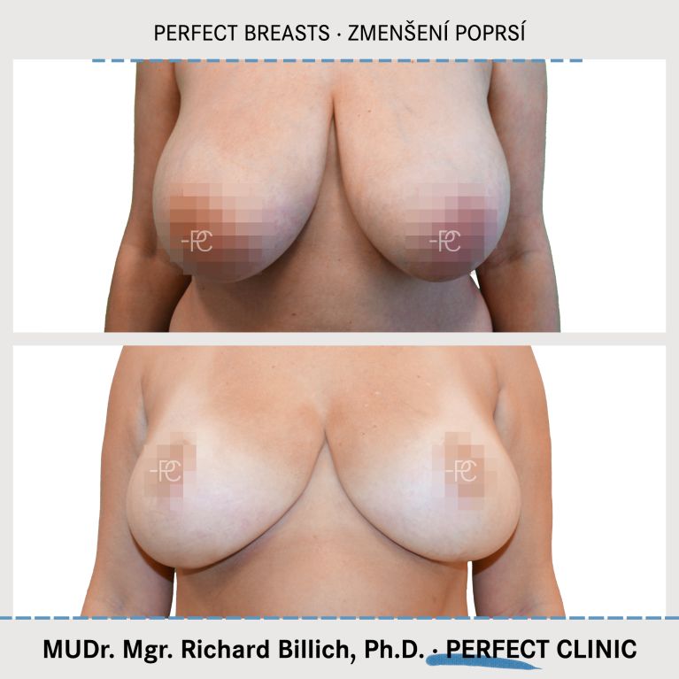 Zmenšení prsou