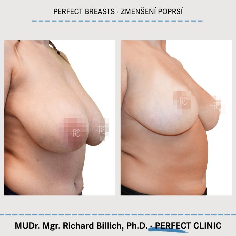 Zmenšení prsou