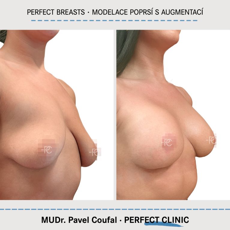 Modelace prsou s augmentací