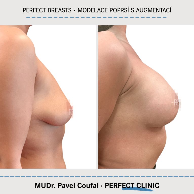 Modelace prsou s augmentací