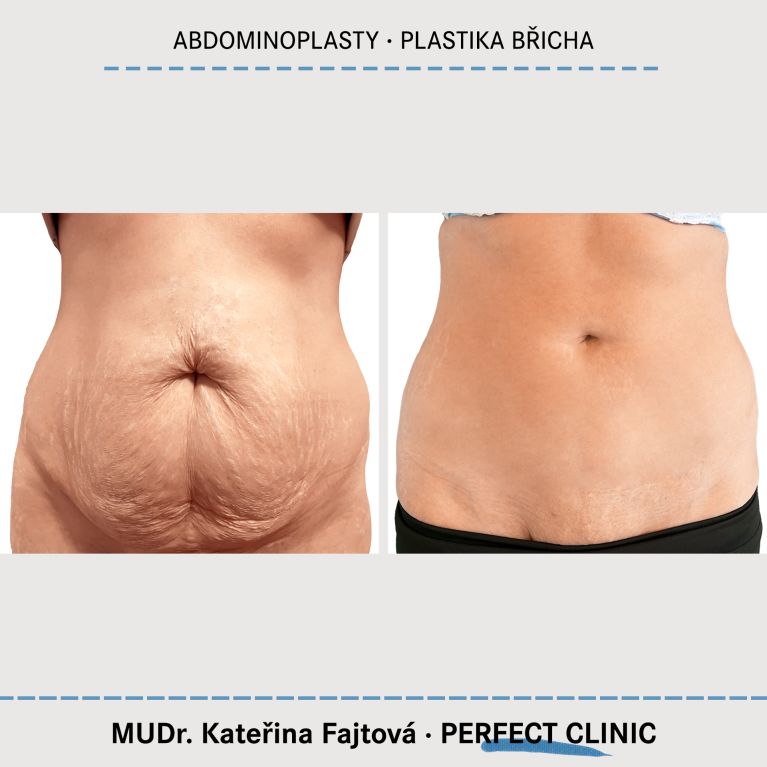 Abdominoplastika