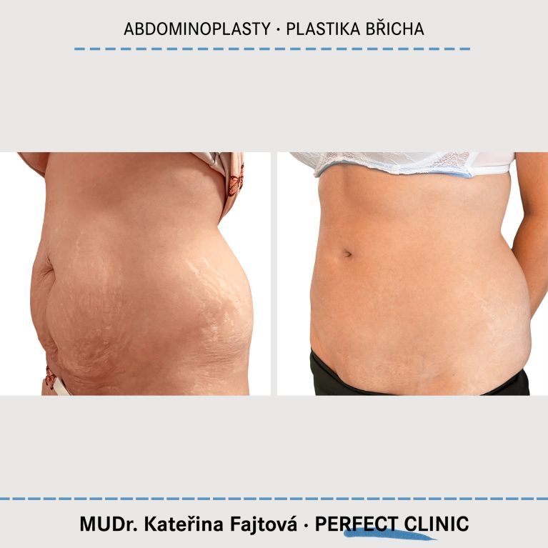 Abdominoplastika