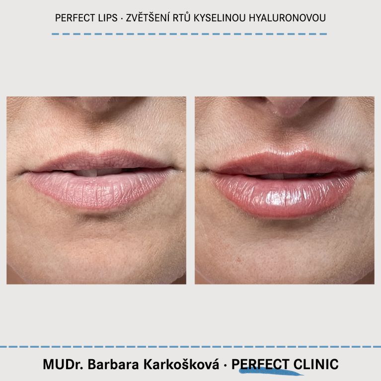 Zvětšení rtů kyselinou hyaluronovou