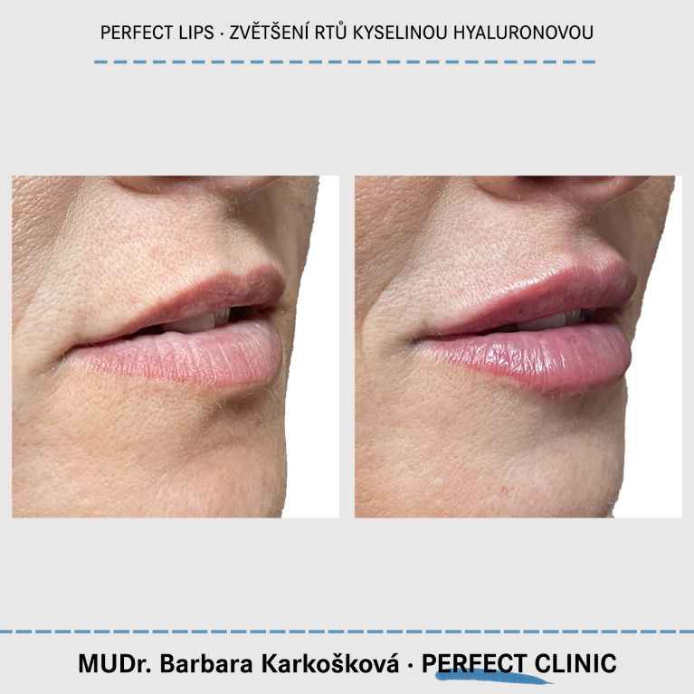 Zvětšení rtů kyselinou hyaluronovou