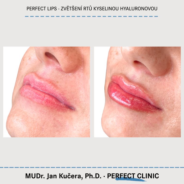 Zvětšení rtů kyselinou hyaluronovou