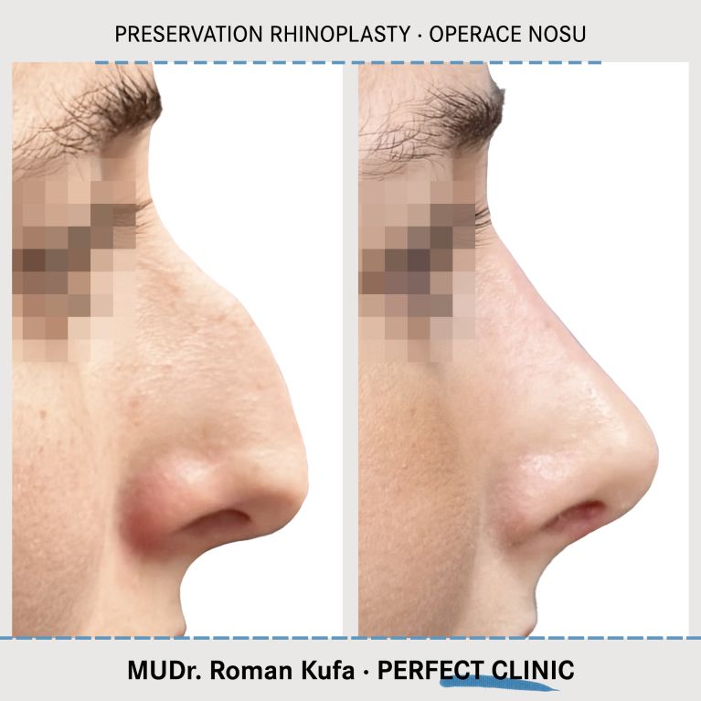 Rhinoplastika