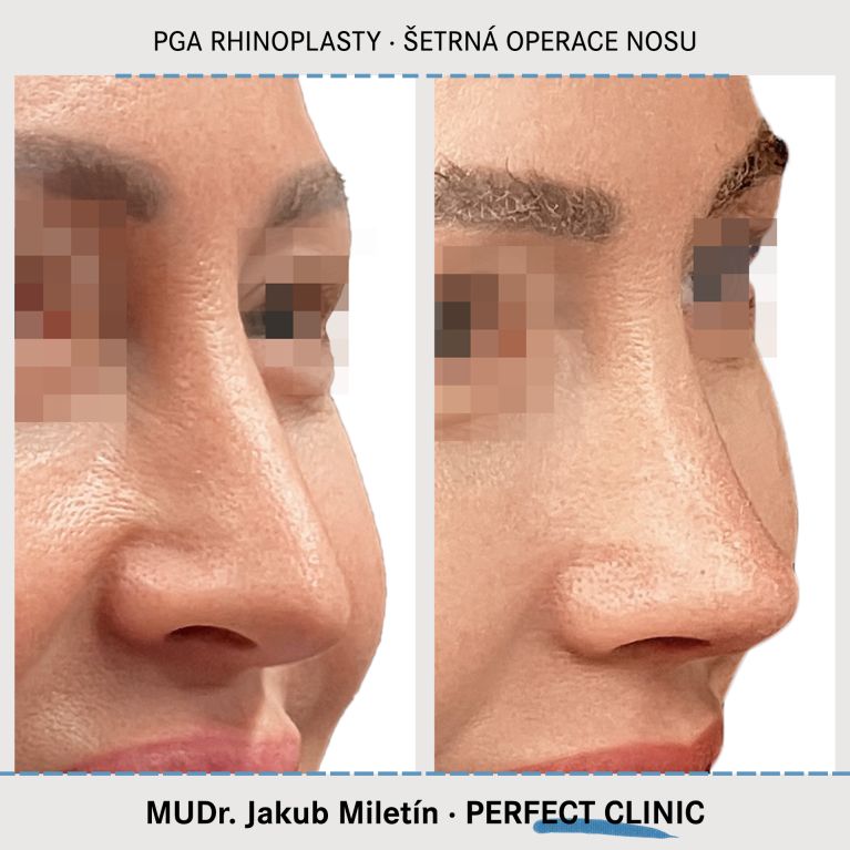 PGA Rhinoplasty