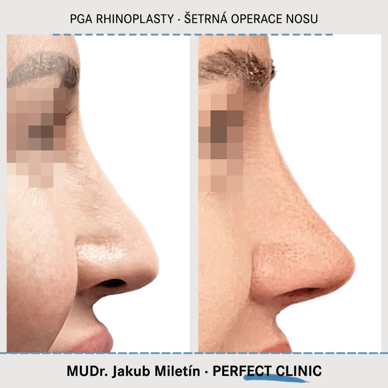 PGA Rhinoplasty