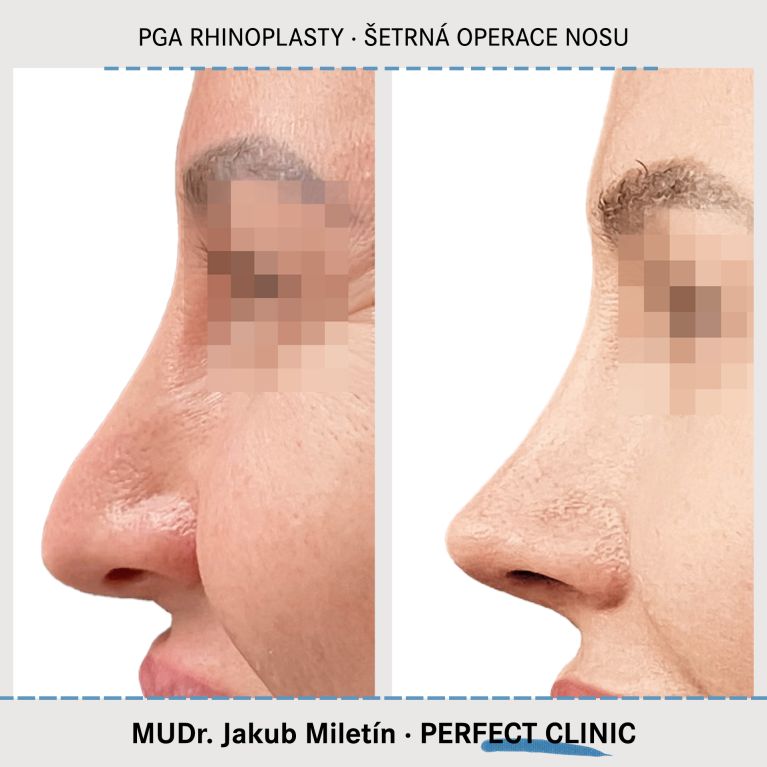 PGA Rhinoplasty