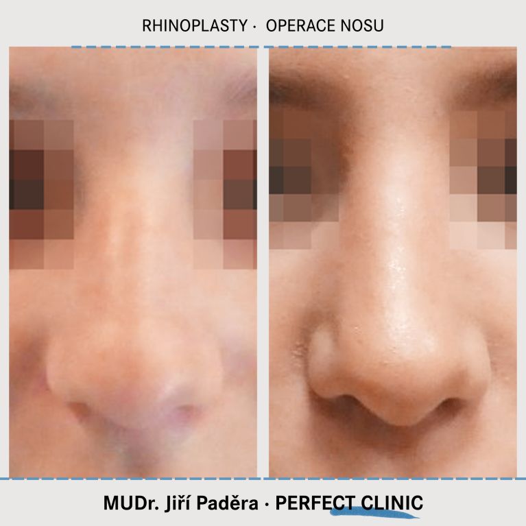 Rhinoplastika