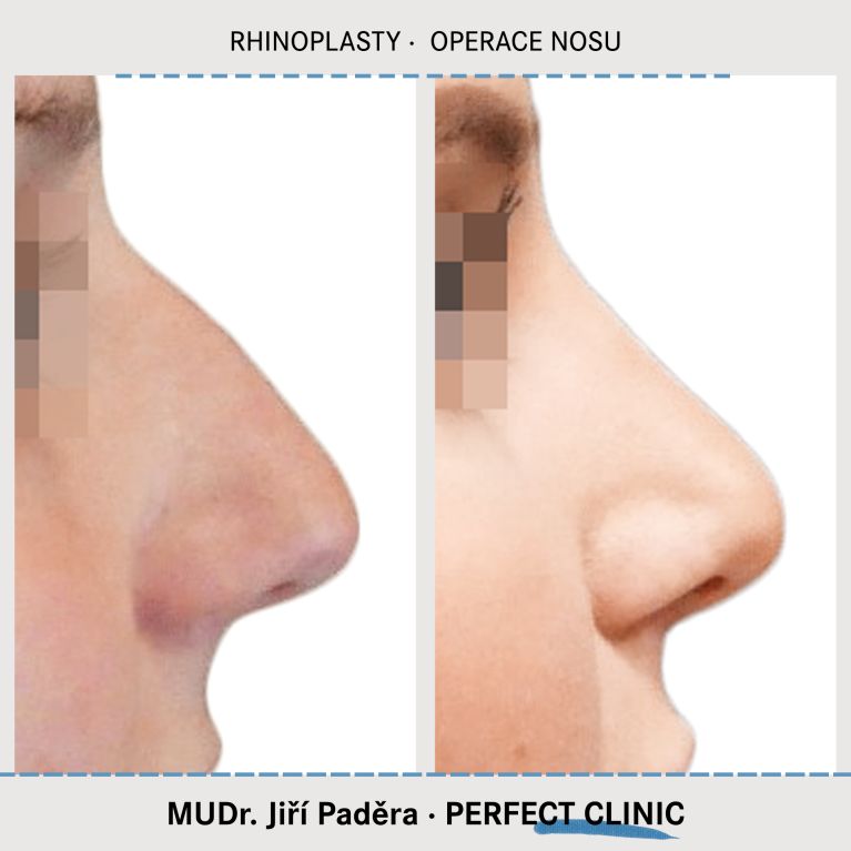 Rhinoplastika