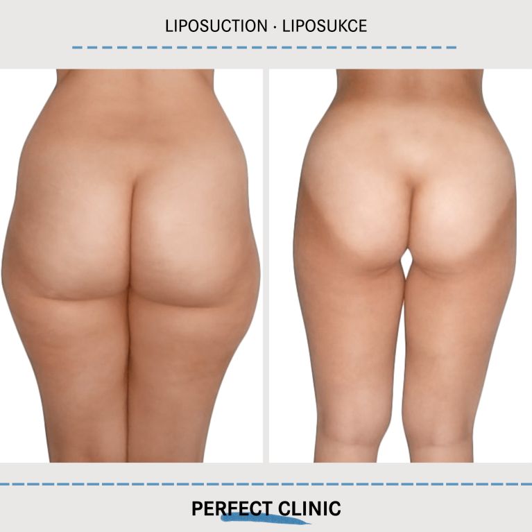 Liposukce