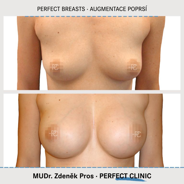 Augmentace poprsí