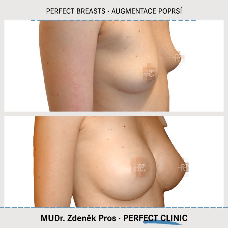 Augmentace poprsí